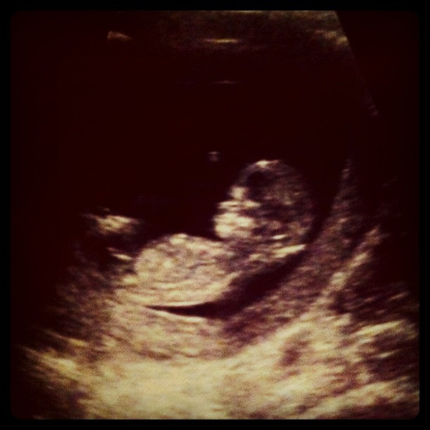first-trimester ultrasound