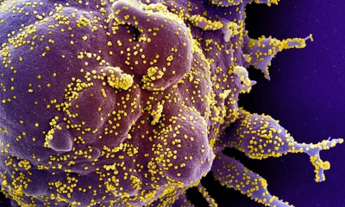 Colorized scanning electron micrograph of an apoptotic cell (purple) heavily infected with SARS-COV-2 virus particles (yellow), isolated from a patient sample