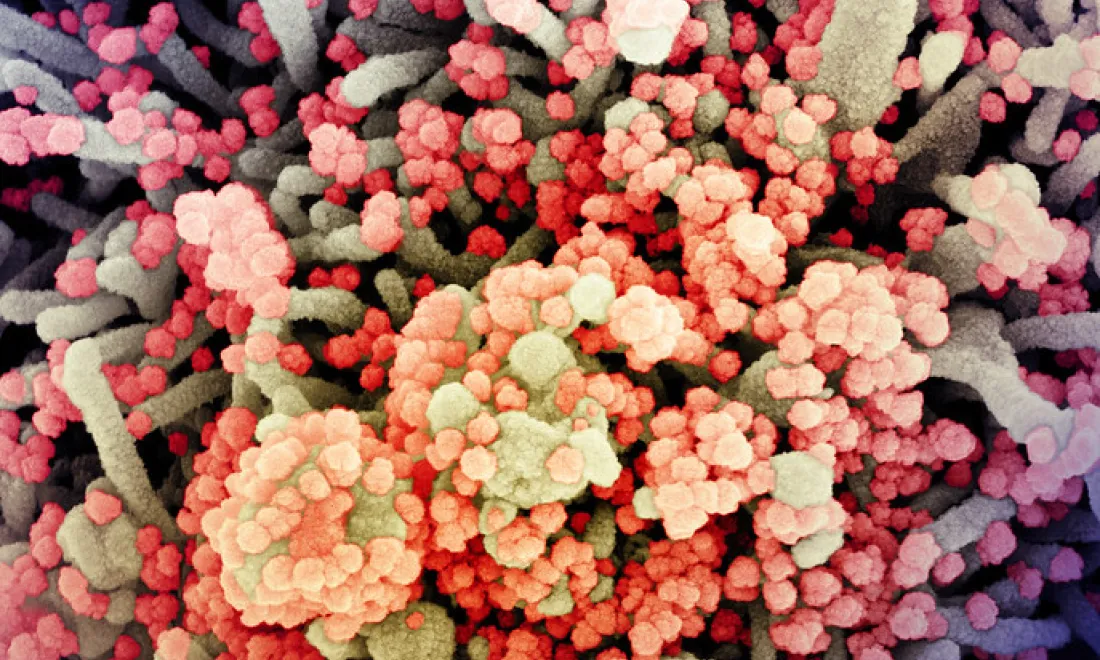 Colourised scanning electron micrograph of a cell heavily infected with SARS-CoV-2 virus particles, isolated from a patient sample. Image captured at the NIAID Integrated Research Facility (IRF) in Fort Detrick, Maryland