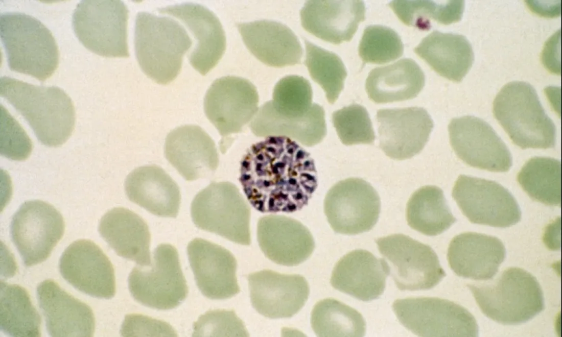 Plasmodium vivax malaria infection