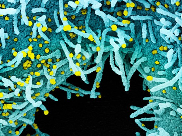Colorized scanning electron micrograph of a cell heavily infected with SARS-CoV-2 virus particles (yellow), isolated from a patient sample.
