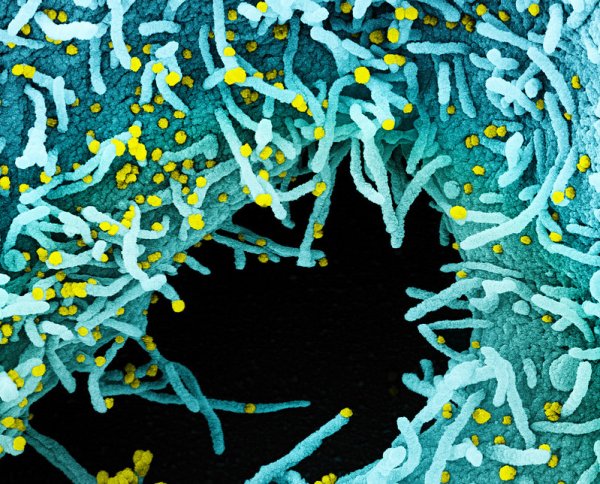 Colorized scanning electron micrograph of a cell heavily infected with SARS-CoV-2 virus particles (yellow), isolated from a patient sample.