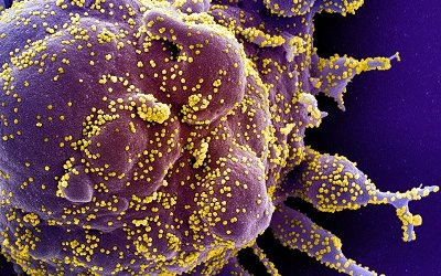 Colorized scanning electron micrograph of an apoptotic cell (purple) heavily infected with SARS-COV-2 virus particles (yellow), isolated from a patient sample