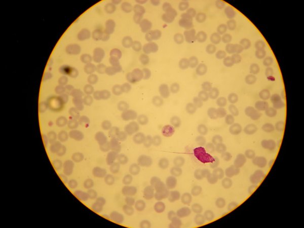 Plasmodium vivax malaria infection