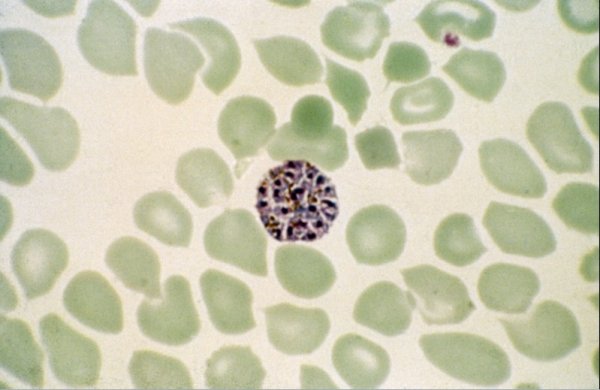 Plasmodium vivax malaria infection