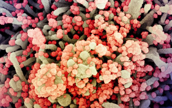 Colourised scanning electron micrograph of a cell heavily infected with SARS-CoV-2 virus particles, isolated from a patient sample. Image captured at the NIAID Integrated Research Facility (IRF) in Fort Detrick, Maryland